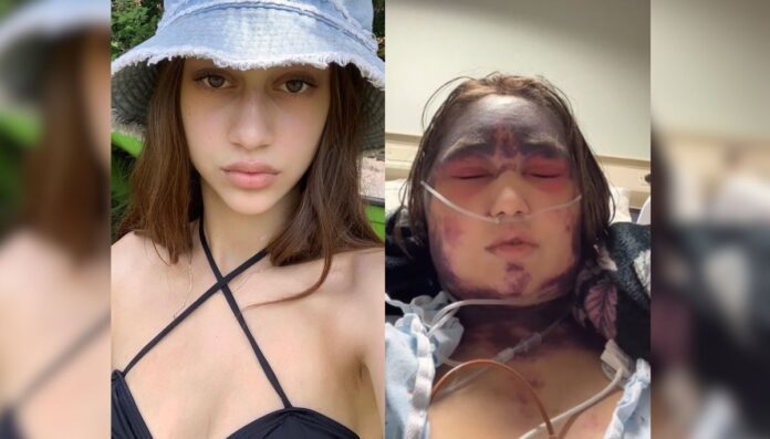 Before and after Alexis Lorenze's transformation after a severe vaccine reaction Before and after Alexis Lorenze's transformation after a severe vaccine reaction